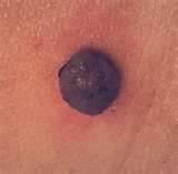 Come e quando controllare i propri nei