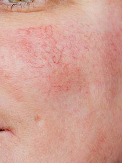Come riconoscere la Rosacea (Couperose) e la Micosi