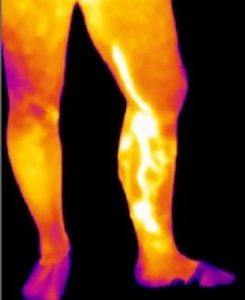 2prima-vene-varicose