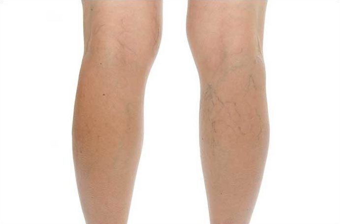 Trattamento varici: l’efficacia dell’ablazione non termica con cianoacrilato