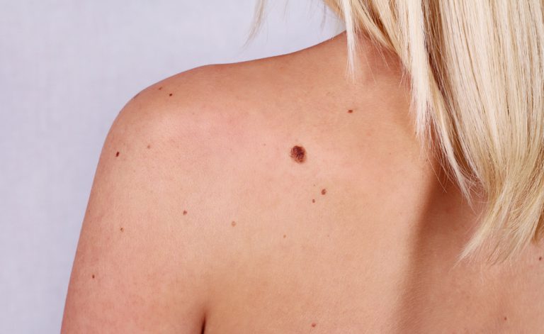 Nei sospetti: in quali casi si rende necessaria l’asportazione?