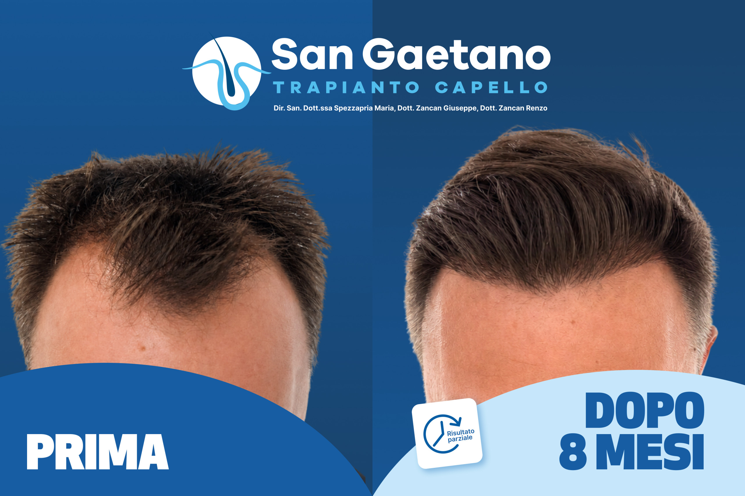 Trapianto Capello San Gaetano Thiene - Risultato Prima e Dopo Trapianto Capello San Gaetano Thiene - Risultato Prima e Dopo