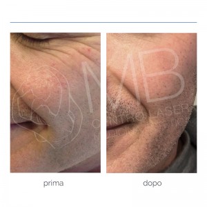 Couperose: cos’è e come trattarla? Couperose: cos’è e come trattarla?