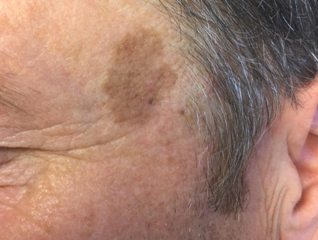 Dermolaserchirurgia Cheratosi seborroiche