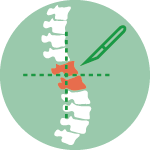 Nucleoplastica con Laser per Ernia Nucleoplastica con Laser per Ernia