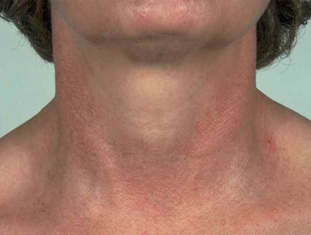 Quello che è a trombosi di intestini