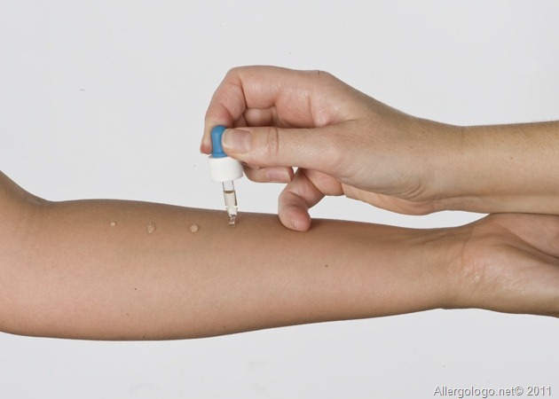 Prick test - thiene vicenza