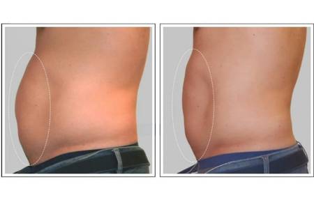 criolipolisi prima e dopo