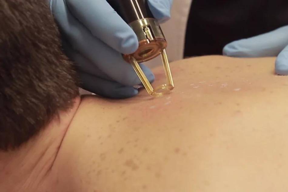 trattamento macchie solari estetica buratto trattamento macchie solari estetica buratto