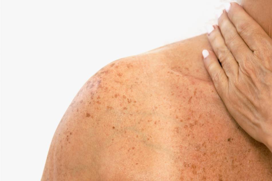 macchie-solari-sul-viso-spalle-e-decolette-come-rimuoverle macchie-solari-sul-viso-spalle-e-decolette-come-rimuoverle