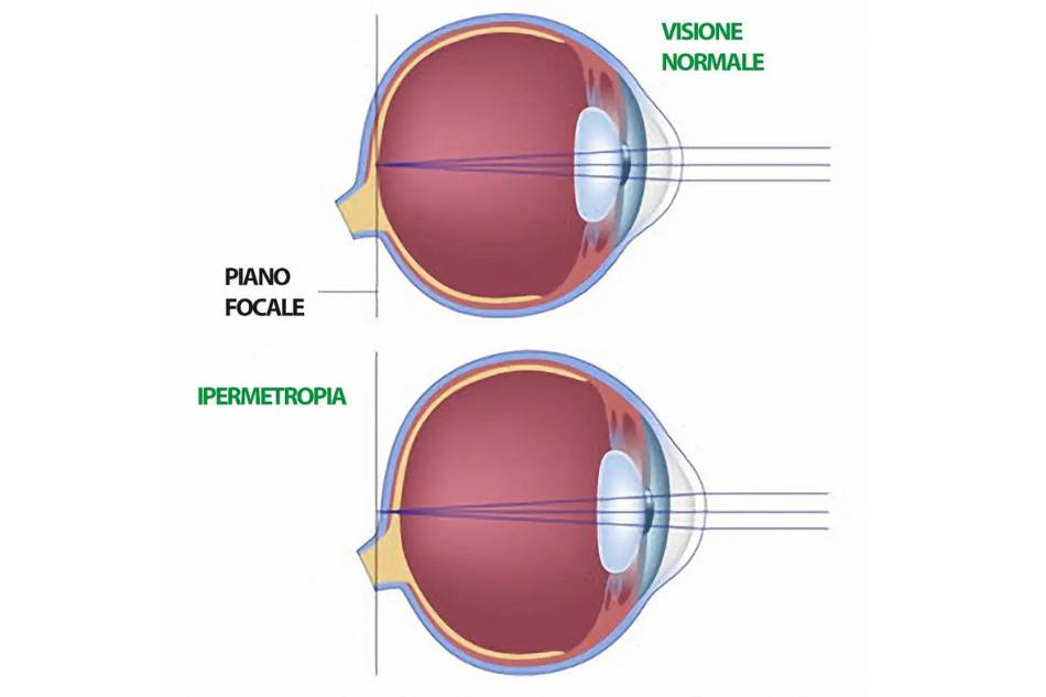 ipermetropia bambini ortottica