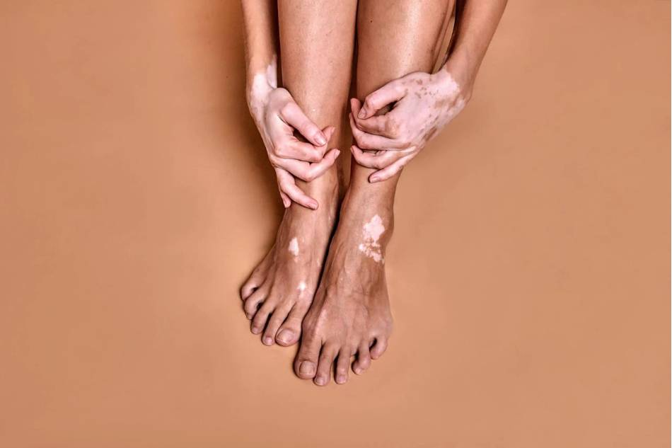 giornata mondiale della vitiligine