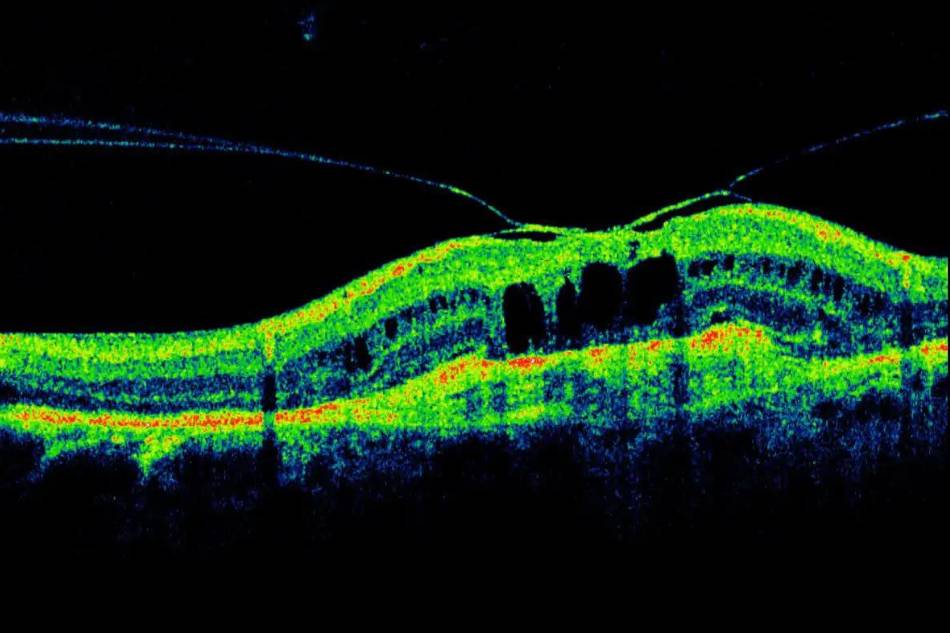 cosa e oct tomografia ottica computerizzata