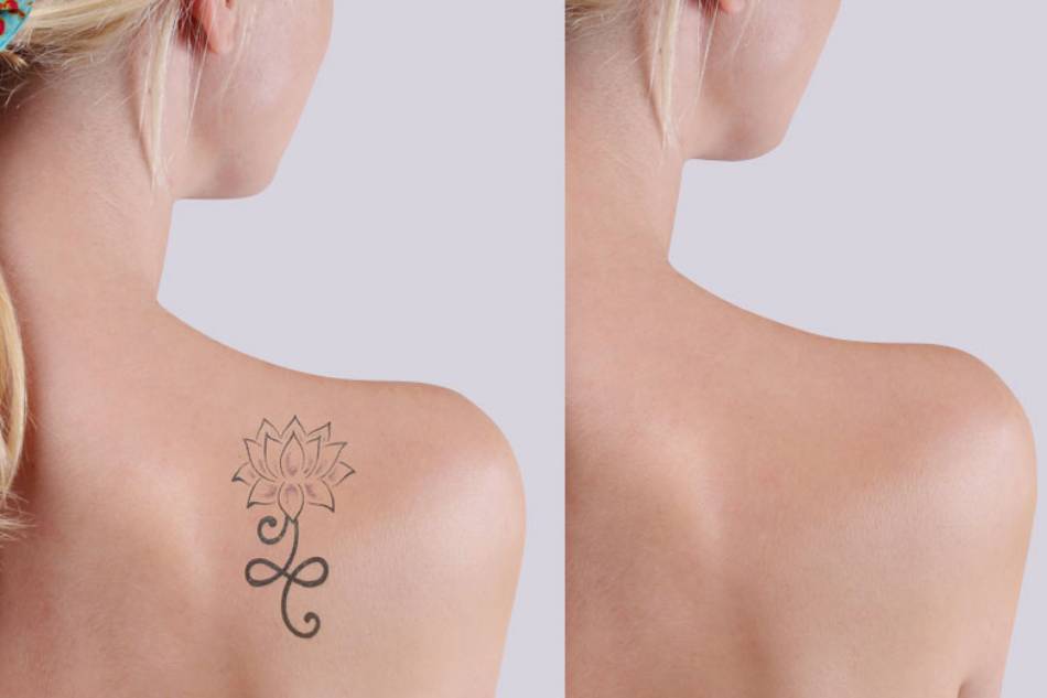 rimozione tatuaggio poliambulatorio san gaetano