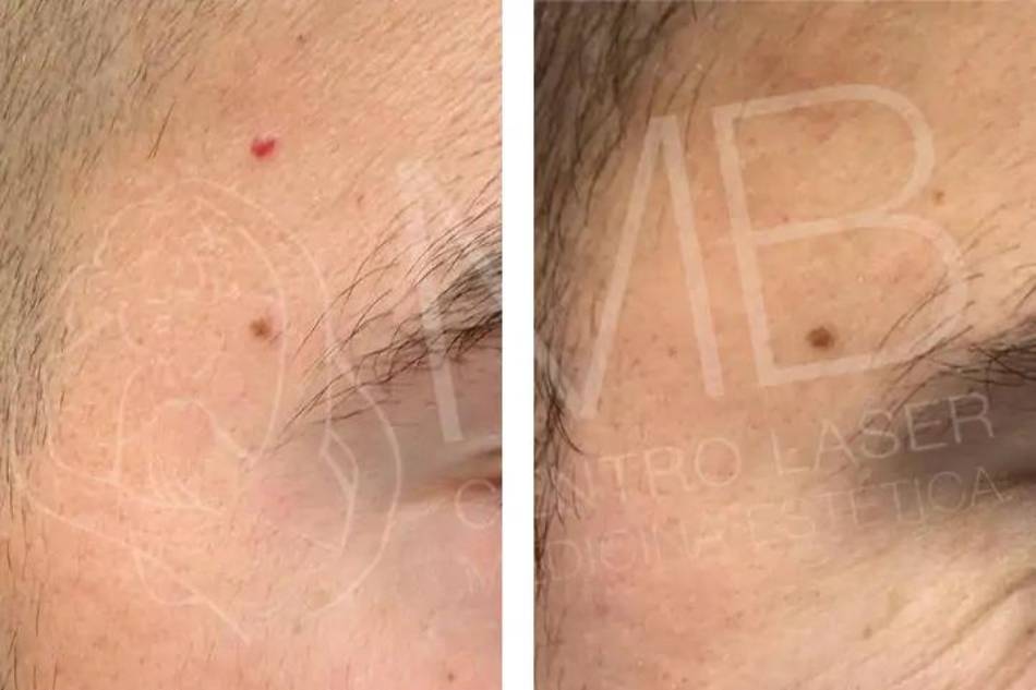 Angioma: che cos’è? Cause, trattamenti e tipologie