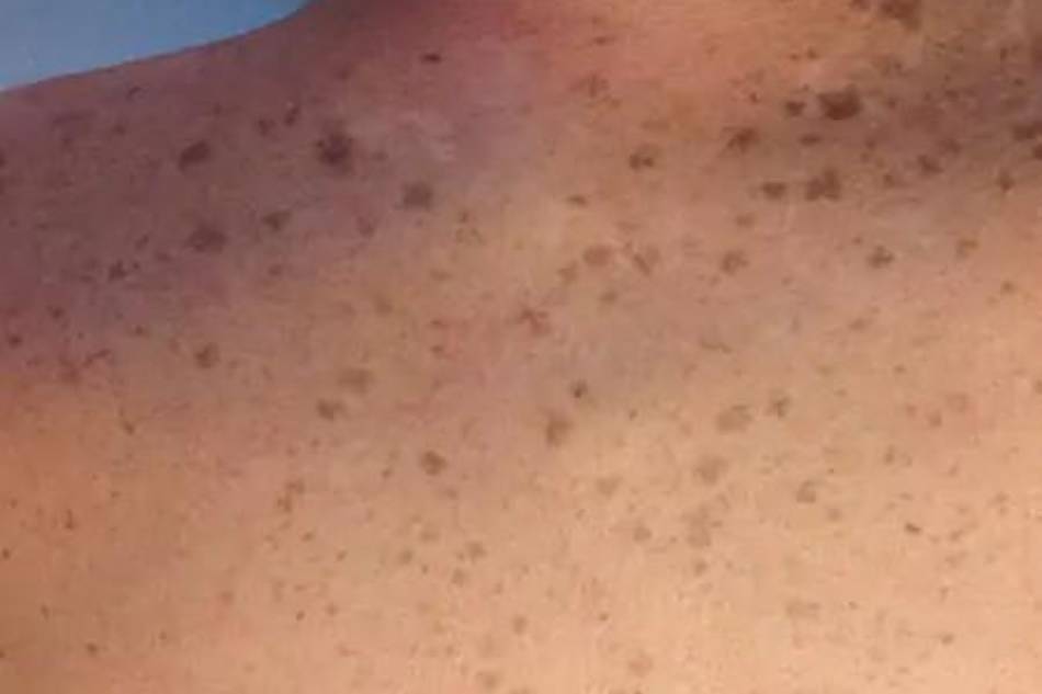 macchie della pelle trattamento medicina estetica