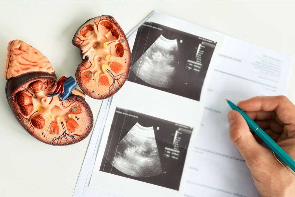 calcoli-reni-diagnosi-thiene-schio-vicenza