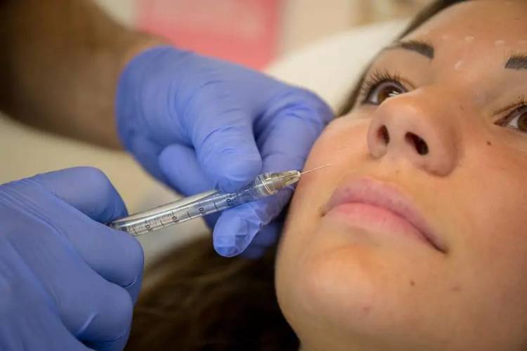filler acido ialuronico thiene vicenza