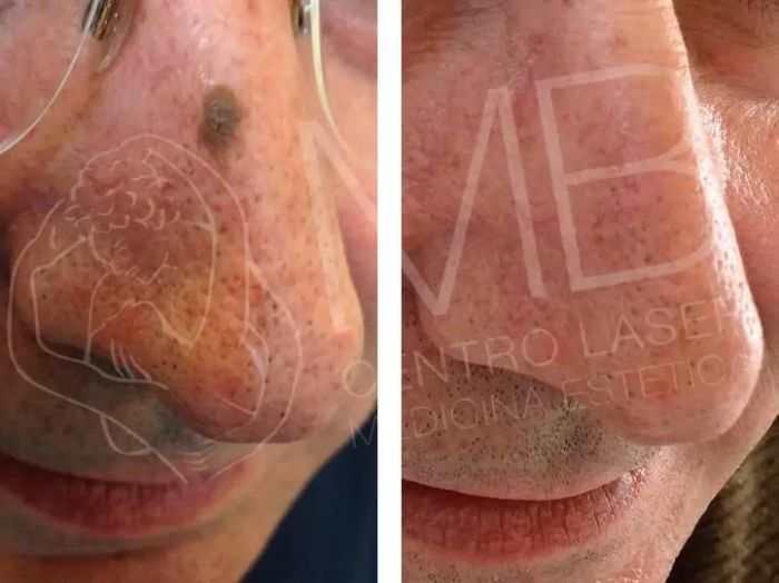 Dermolaserchirurgia Cheratosi seborroiche Vicenza
