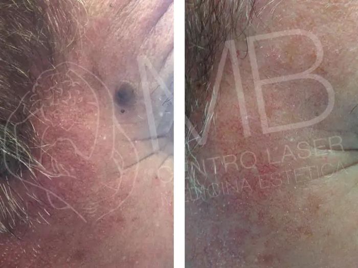 Trattamenti laser Cheratosi seborroiche Thiene