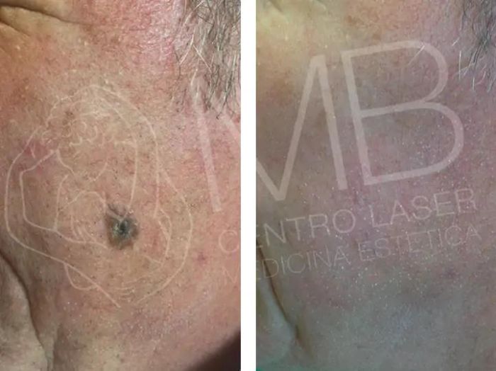 Trattamenti laser Cheratosi seborroiche Vicenza