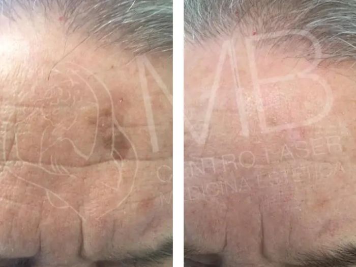 Trattamenti laser Cheratosi seborroiche