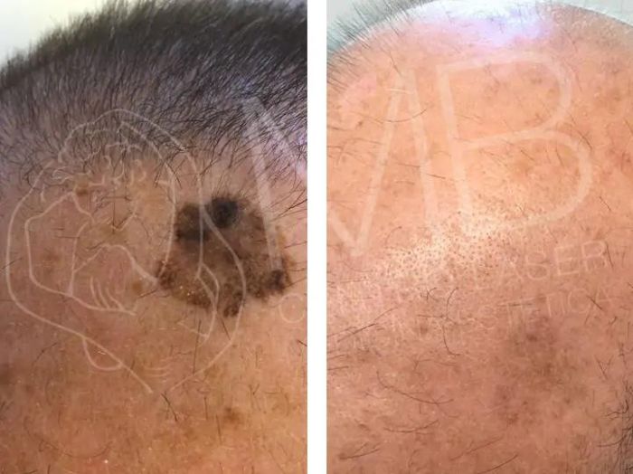 Trattamento dermolaserchirurgia Cheratosi seborroiche