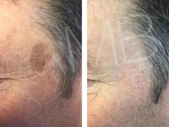 Cheratosi seborroiche Thiene