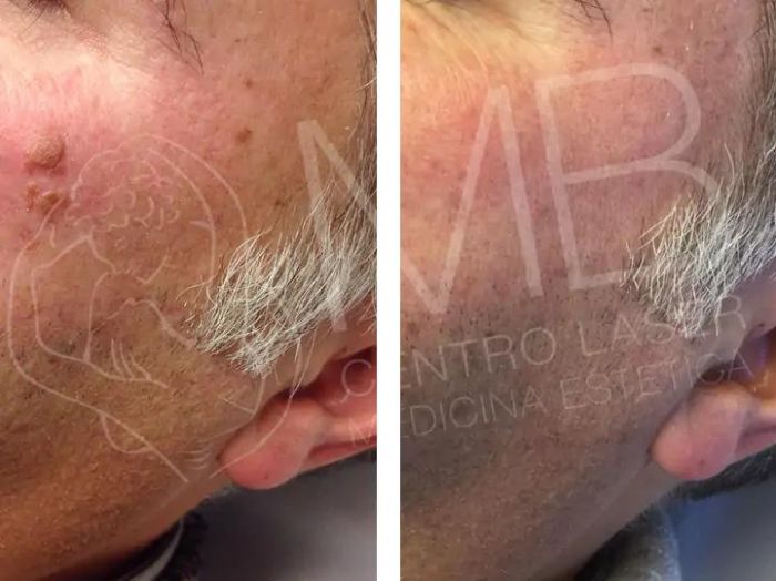 Cheratosi seborroiche Vicenza