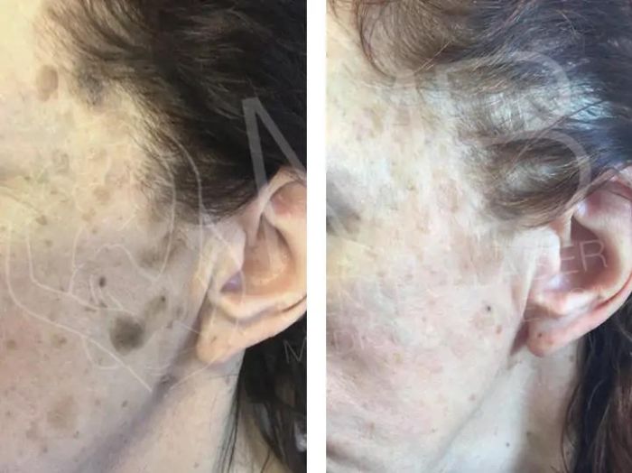 Dermolaserchirurgia Cheratosi seborroiche Thiene