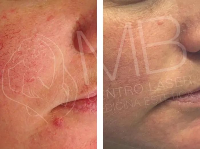 trattamento laser couperose vicenza