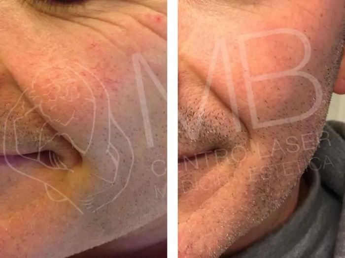 trattamento laser couperose thiene