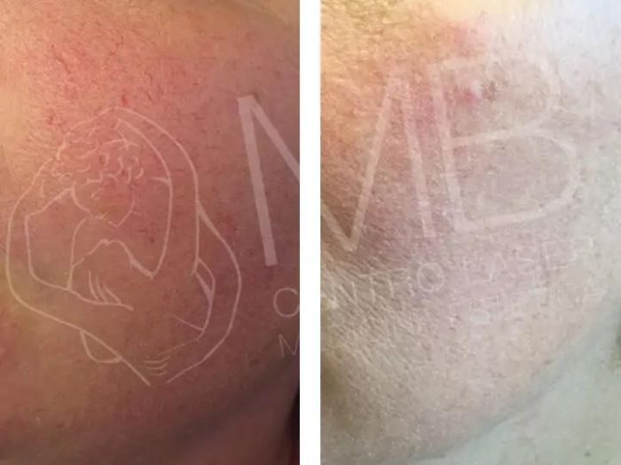 laser vascolari couperose vicenza