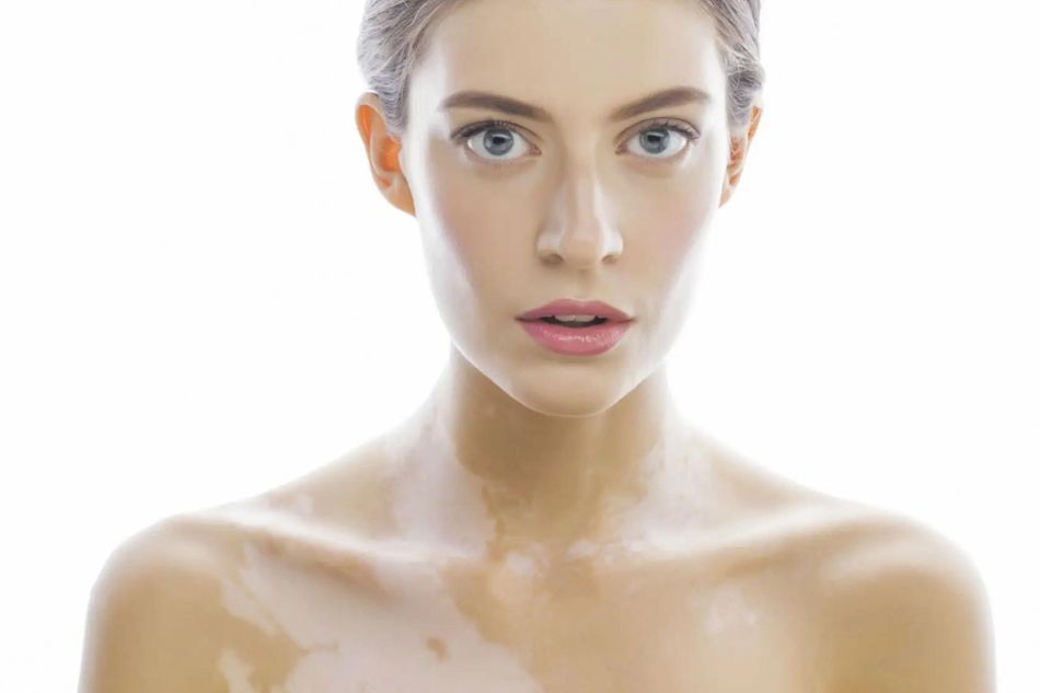 Vitiligine: cos’è e come si cura. La scoperta del Dott. Matteo Bordignon