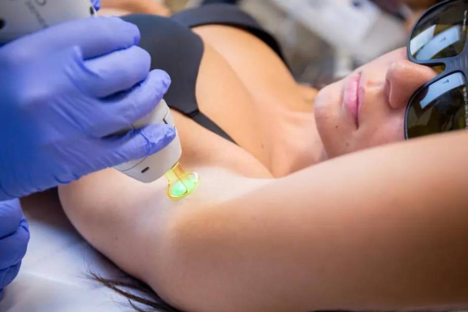 A che età si può cominciare a fare l’epilazione laser?