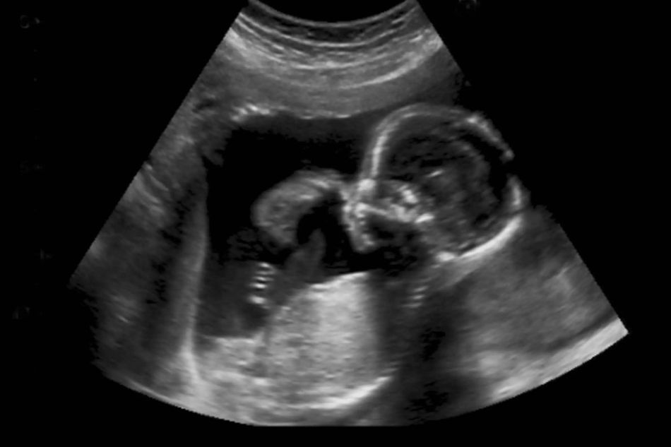 B-test translucenza nucale Thiene Schio Veneto