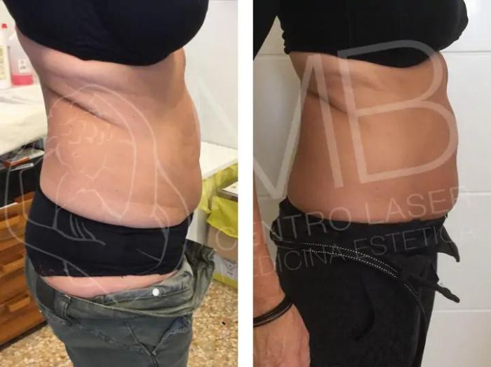 Cellulite e adiposità