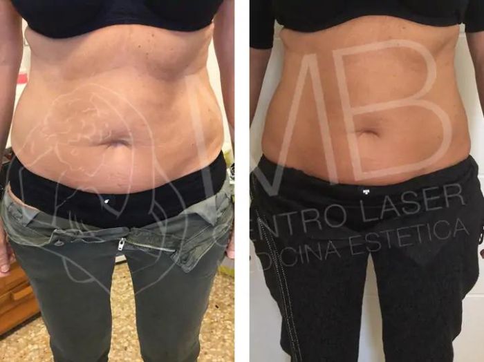 Cellulite e adiposità