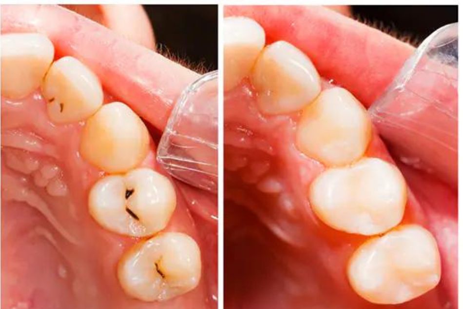 odontoiatria conservativa studio dentistico spezzapria zancan