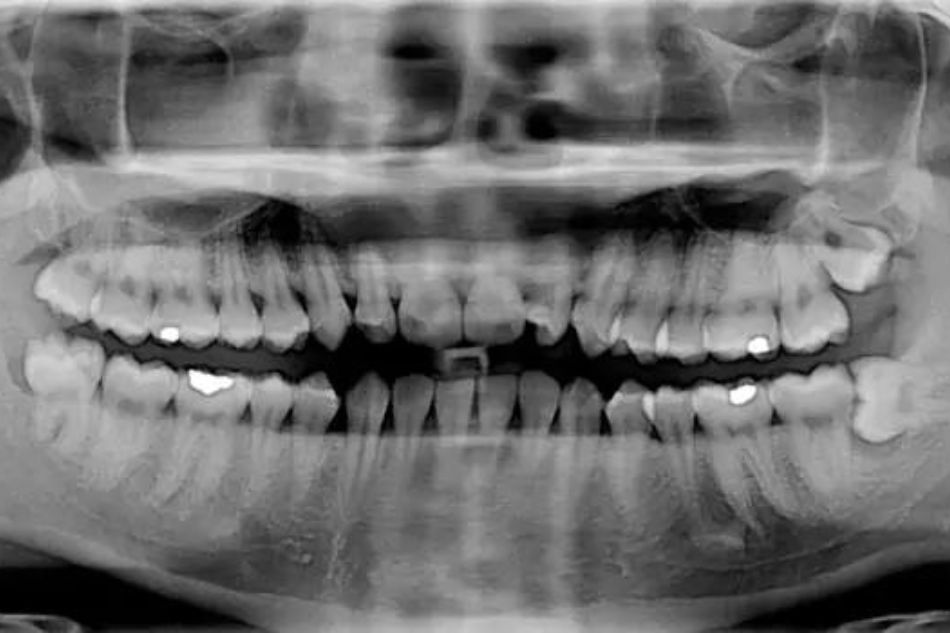 perche panoramica dentale