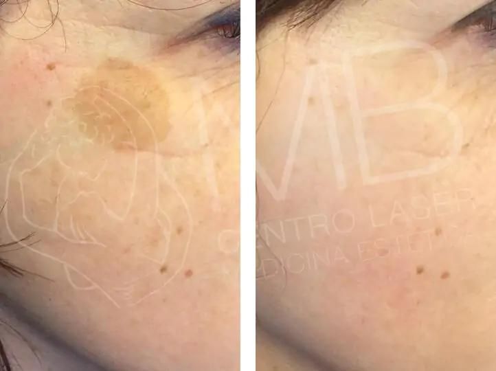 discromie Macchie della pelle thiene