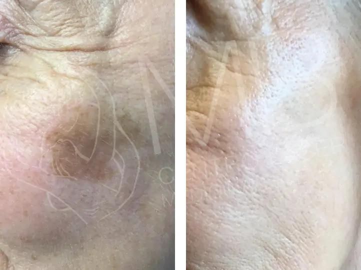 discromie Macchie della pelle vicenza