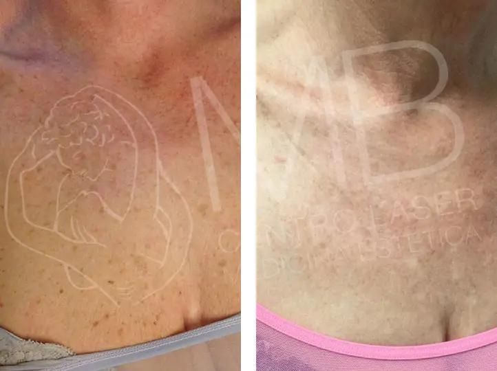 discromie Macchie della pelle vicenza