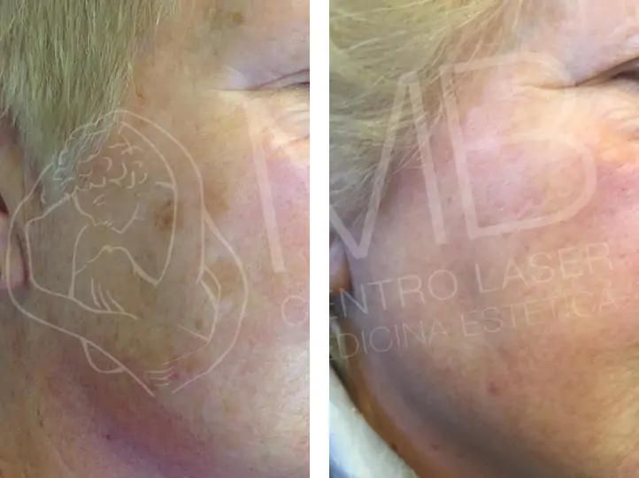 trattamento Macchie della pelle vicenza