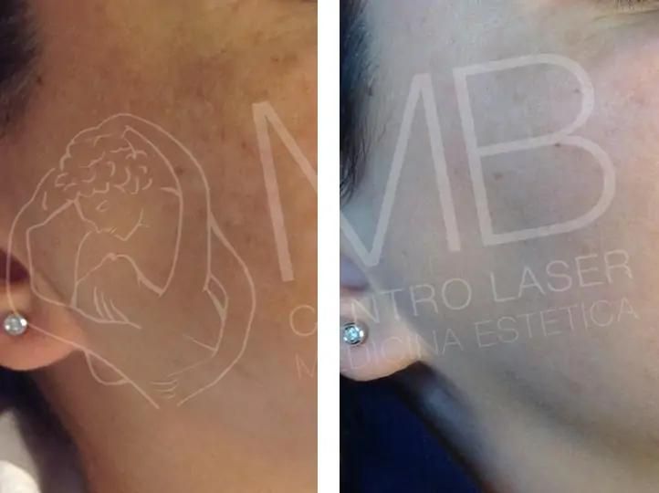 trattamento Macchie della pelle