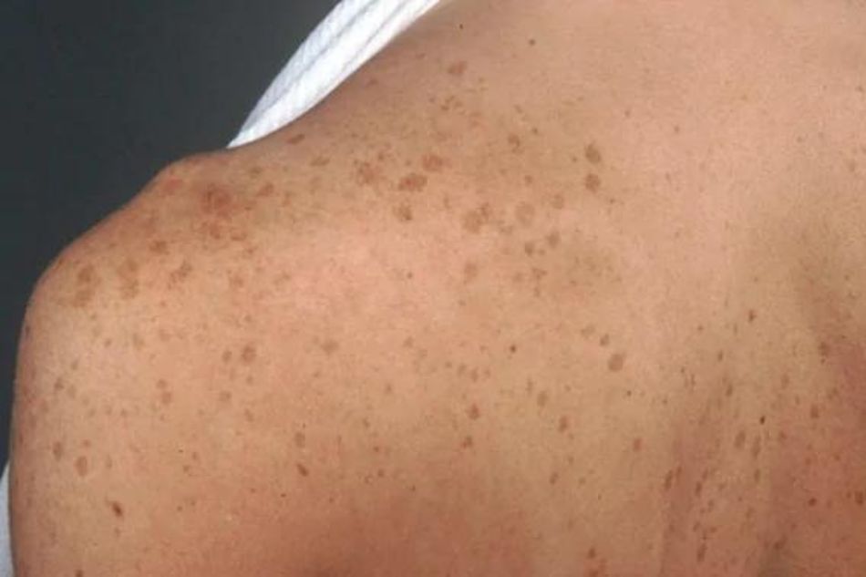 eliminare le macchie della pelle medicina estetica buratto thiene 