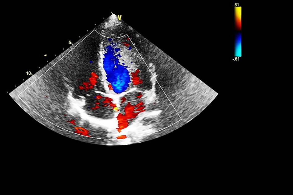 ecografia color doppler vasi sanguigni thiene schio