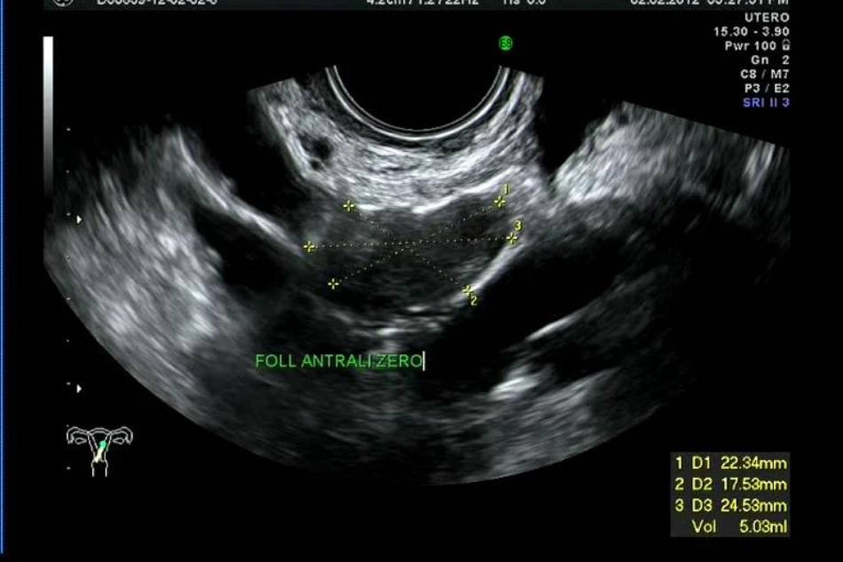 Ecografia monitoraggio ovarico Poliambulatori San Gaetano