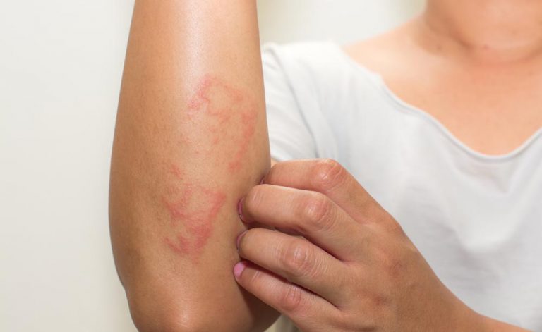 Psoriasi: di cosa si tratta? Parliamone con il Dermatologo Psoriasi: di cosa si tratta? Parliamone con il Dermatologo