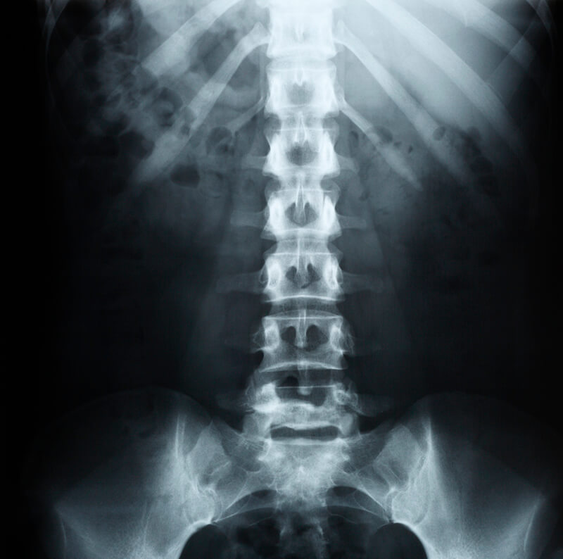 Raggi Rachide - thiene vicenza